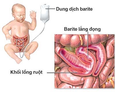 Một số chứng đau bụng cần phải phẫu thuật ở trẻ nhỏ